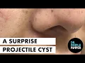 Lagu A Surprise Projectile Pilar Cyst