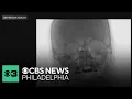 Jefferson Health is testing a new less invasive treatment for a brain disorder