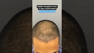 15 DAY TRANSFORMATION See His Hair Before and After Sapphire FUE Hair Transplant