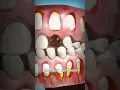 How Adult Teeth Grow In