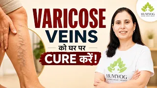 Varicose Veins को घर पर Manage करें | Yoga and Ayurveda से पाएं राहत | Humyog | Radhesa |