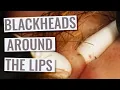 Gebhard The Q-Tips Deep Blackheads Around The Lips