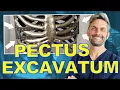 Surgical Options for a Sunken Chest Pectus Excavatum