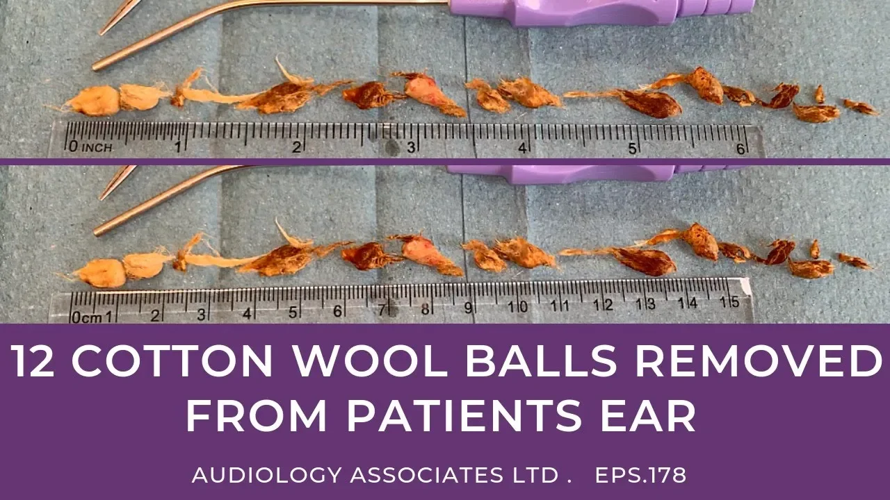 ' ----------------------------------------------- ID: 1504761 A man had a cotton bud removed from hi. 