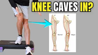 Dynamic Knee Valgus: 3 Exercises to Improve Knee Control