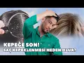 Lagu Kepeğe Son! Saç Kepeklenmesi Neden Olur?