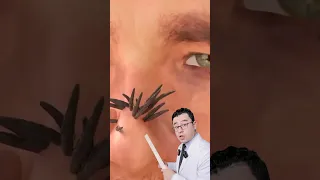 اسهل طريقة للتخلص من الرؤوس السوداء 