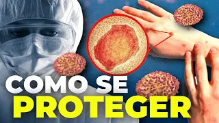 MPOX: COMO SE PROTEGER
