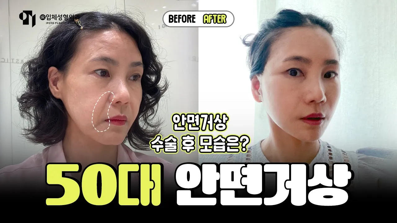 안면거상+목거상 수술 후 2주차 후기 (통증, 감각, 붓기, 회복과정)