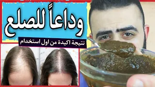التركيبة الثلاثية بدون زيوت لعلاج الصلع و انبات الشعر نتيجة اكيدة من اول استخدام 