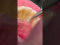 Lagu Scaling \u0026 cleaning tartar #teeth #tooth #satisfying