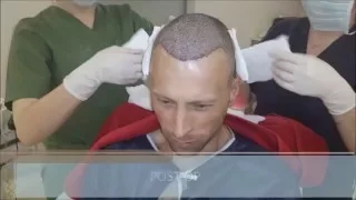 FUE Hair Transplant Growth Timeline - Health Travel International
