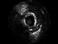 CSI Diamondback proximal LAD case