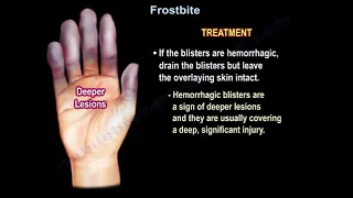 Frostbite Symptoms Diagnosis Treatment and Prevention.