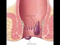 Incision of Thrombosed Hemorrhoid CPT code - simplify medical coding