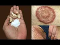 Download Lagu Comment traiter rapidement la teigne || Remède maison contre les infections fongiques de la peau