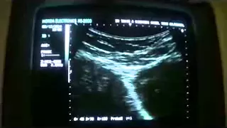 DIFFUSE MYOMETRITIS with DILATED FALLOPIAN TUBE