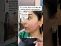 Does your skin get worse before it gets better on accutane