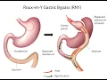 Roux en Y gastroenterostomy CPT code - simplify medical coding