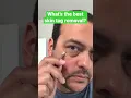 Download Lagu Best Skin Tag Removal At Home #shorts