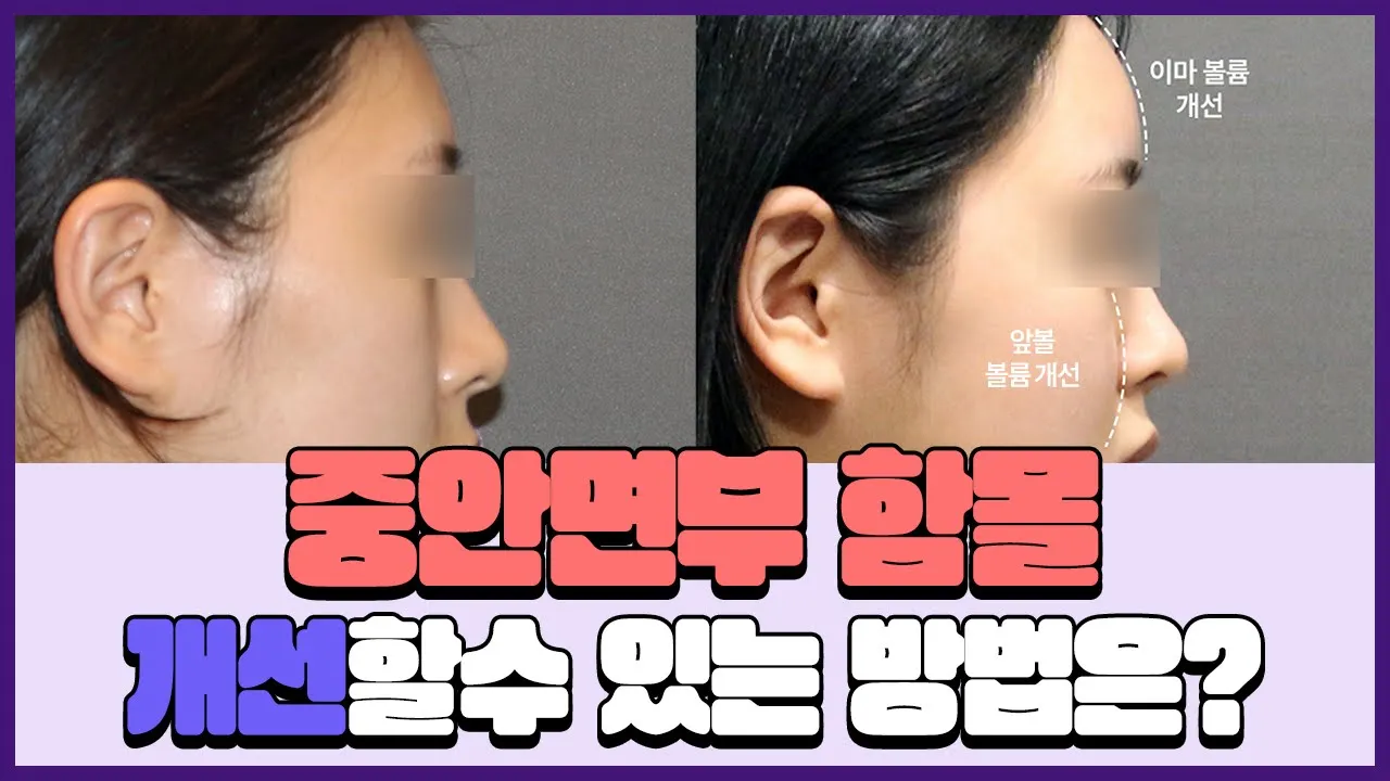 중안면부 꺼짐, 함몰을 해결하는 최근 수술방법🤩