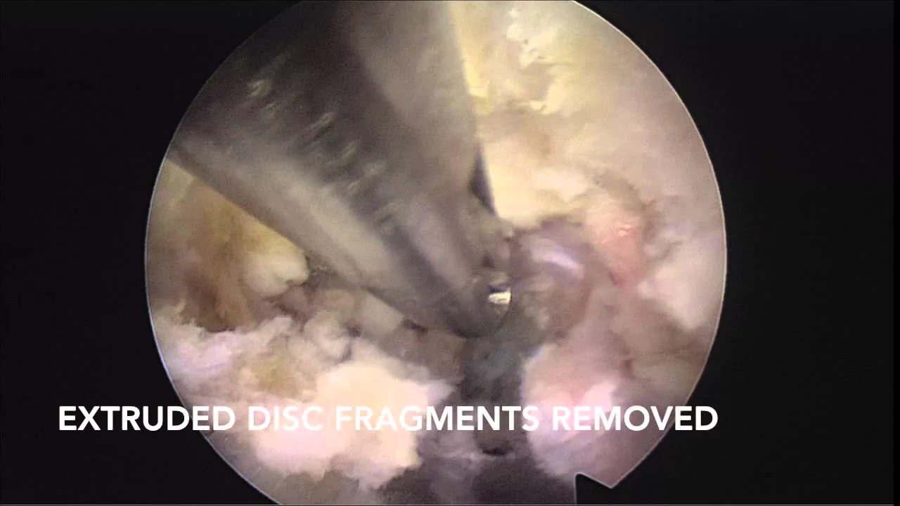 L5 S1 Disc Bulge Exercises - Lumbar Radiculopathy Treatment. 