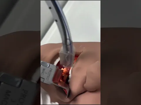 Intubación endotraqueal