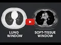 CT Window Width Window Level Explained Image Optimization Made Easy