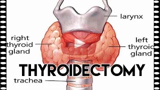CCO CPC Exam Exercises Thyroidectomy Practice Exam Question