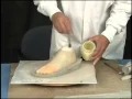 Custom Fabrication of A Silicone Partial Foot Prosthesis