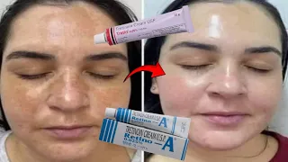 How To Use Retino A - 0.025%, Retino A - 0.1% & Retino A - 0.05% Cream For Skin Peeling