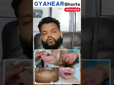 Crotarex Cream Review #doctor #health #allergy