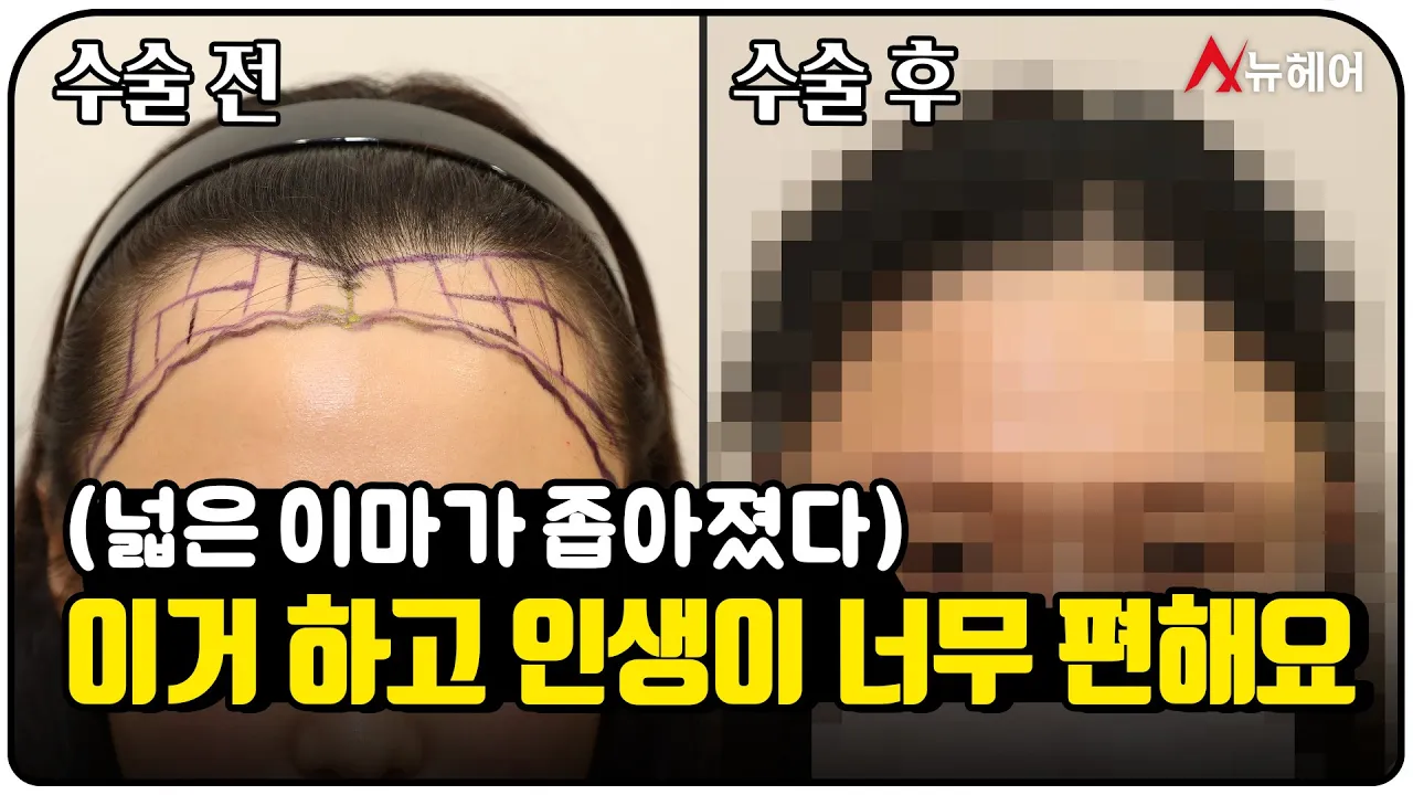 넓은 이마 때문에 고생했는데 이거 하고 너무 편해요ㅣ뉴헤어