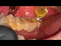Download Lagu PEMBERSIHAN KARANG GIGI | TARTAR | Dokter Gigi Tri Putra