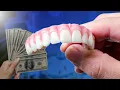 Full Mouth Dental Implant Cost and Comparison