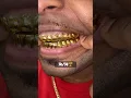14TOP 14BOTTOM Dental Gold 24K picked up at our Jacksonville Florida location