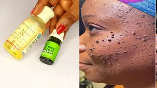 remove skin tag in 1 night 100% effective remedy for skin tag
