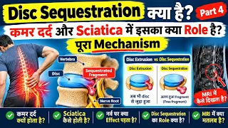 Disc Sequestration क्या है? | कमर दर्द और Sciatica में इसका क्या Role है? | पूरा Mechanism | Part 4