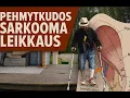 Download Lagu Pehmytkudossarkooman leikkaus | Reiden lihasten poisto ja hermojen säästäminen | onnistuiko?