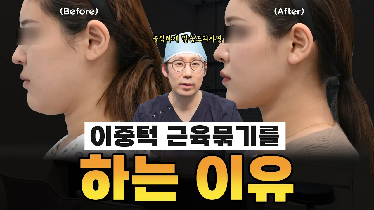 이중턱 근육묶기를 꼭 해야하는 이유는?