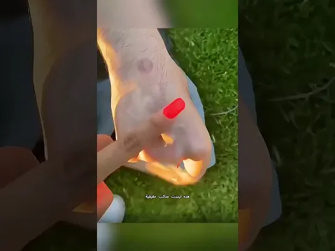 إذا رأيت عنكبوتًا يزحف تحت جلد شخص ما، فلا داعي للذعر! 😱🕷️