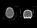 Unremarkible Non Contrast CT Axial Bone Window Example 2