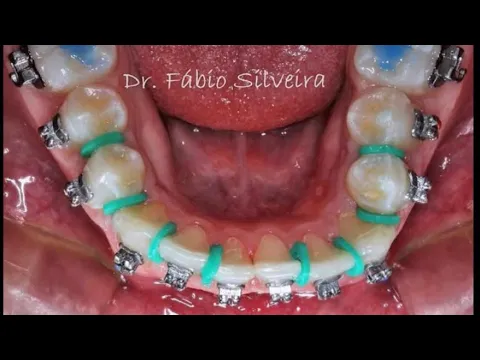 Download MP3 Slice em Ortodontia