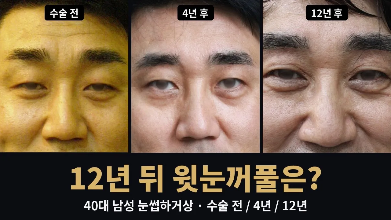#눈썹하거상 #윗눈꺼풀처짐 #측두부리프팅 #미간11자주름 #이마주름 #자연미TV