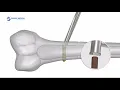 Double Medical Removal of Damaged Screws