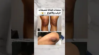 منتجات فعالة لتصبغات الركب والاكواع 