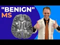 Benign Multiple Sclerosis Explained by Neurologist