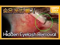 Hidden Eyelash Removal