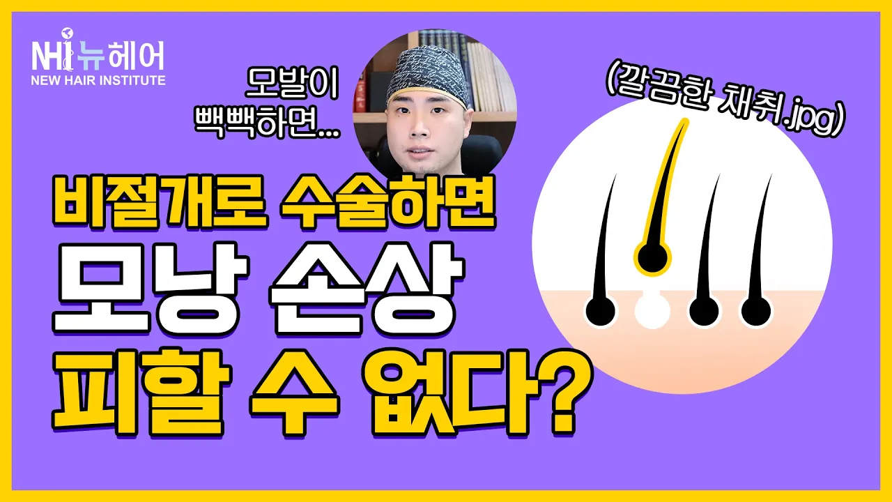 비절개 모발이식 '모낭 손상' 피할 수 없다?ㅣ뉴헤어 [모발이식][모발이식수술]