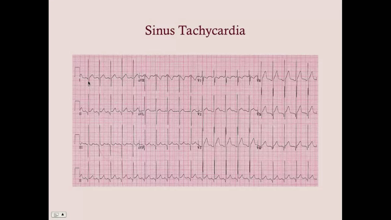 Tachyarrhythmias - CRASH! Medical Review Series